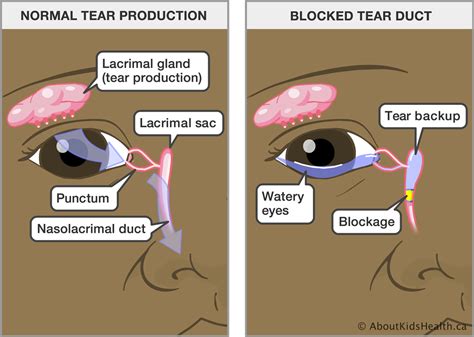 tear drainage test|blocked tear duct symptoms.